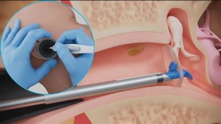 Are Ear Tubes a Scam? No, But Costly Tympanostomies Can Be Avoided.