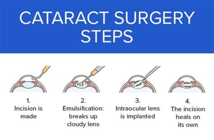 Cataract Surgery: Procedure, Description, Options