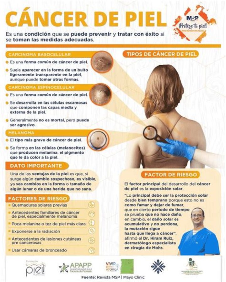 Cómo detectar el cáncer de piel y sus principales síntomas