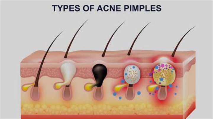 Here's How to Get Rid of That Pesky Pimple, According to Top Derms