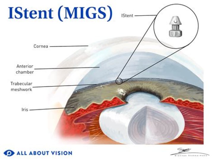 Key Role in Eye Fluid Drainage