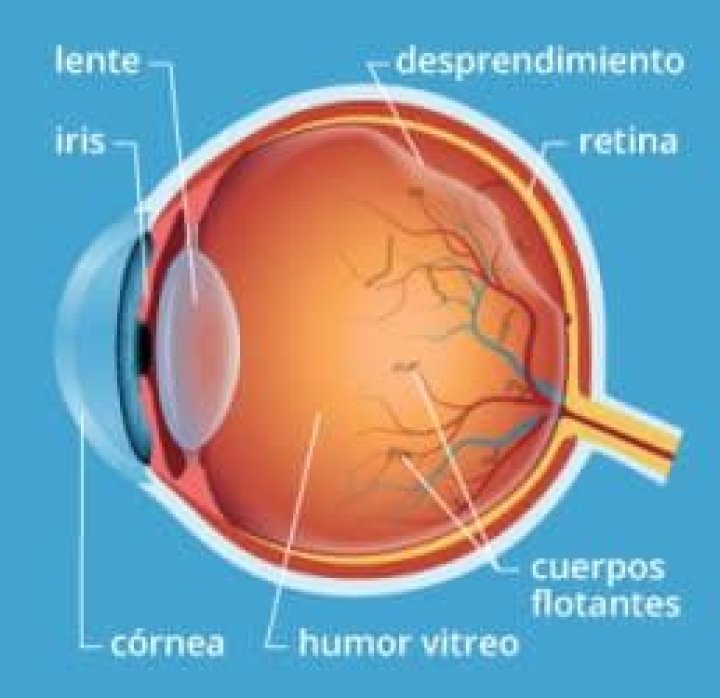 Mideosopsias o moscas en los ojos