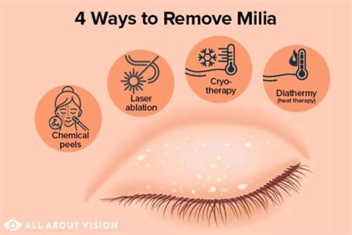 Milia: Causes and Treatment - All About Vision