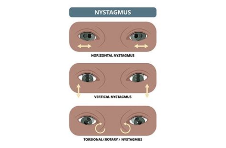 Nystagmus Symptoms - All About Vision