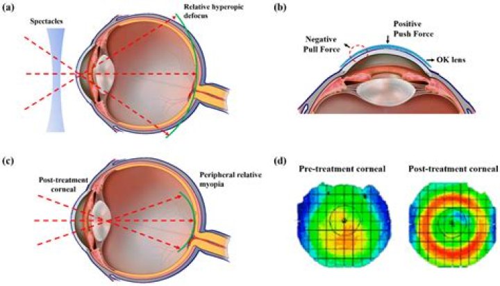 Orthokeratology for Athletes - All About Vision