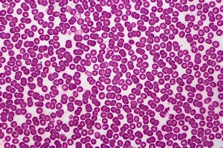 ¿Qué es el GPT en analisis de sangre y qué implica tenerlo alto?