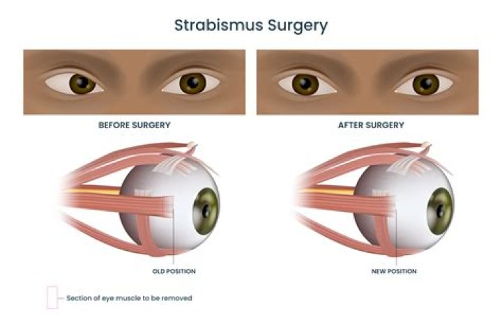 Strabismus Surgery - All About Vision
