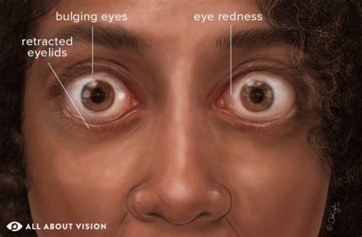 Symptoms, Effects On the Eyes and Treatment