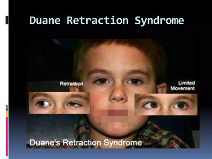 What Is Duane Syndrome? About this Rare Disease