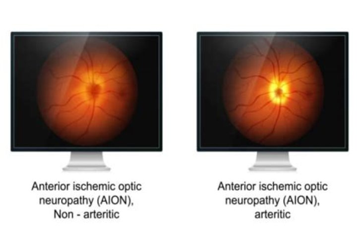 What Is Ischemic Optic Neuropathy (ION)?